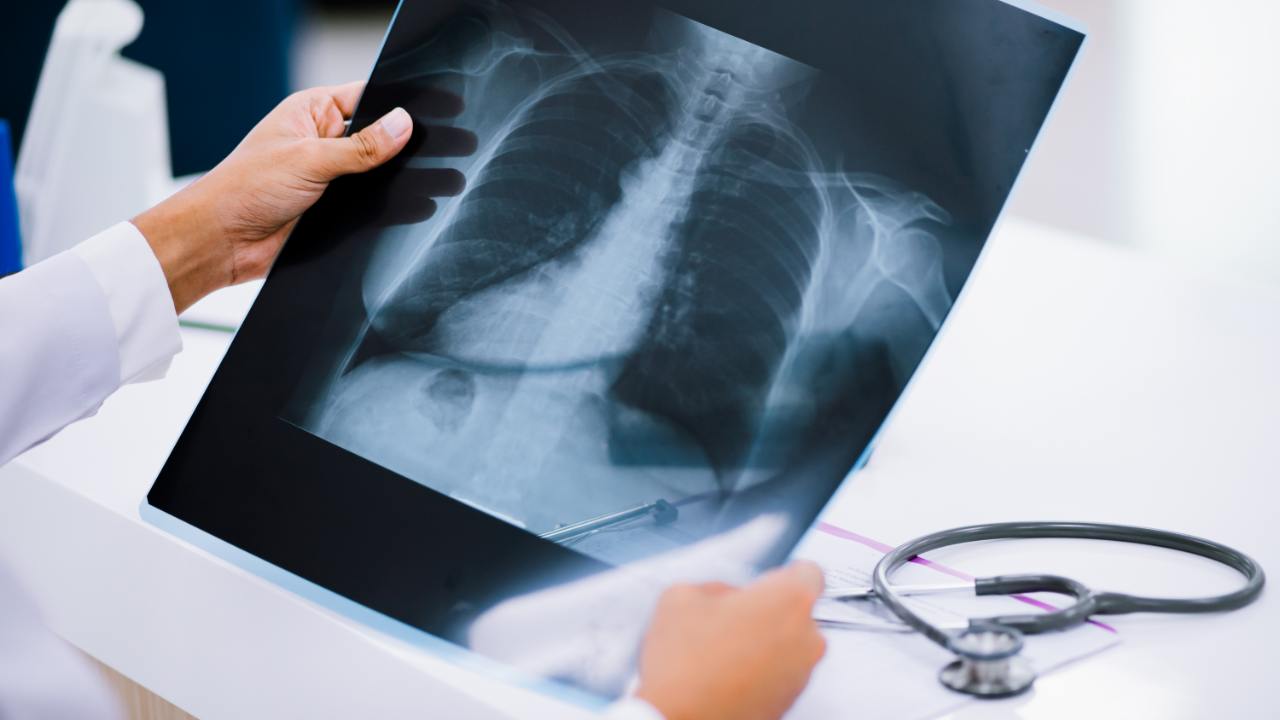 aposentadoria especial radiologia